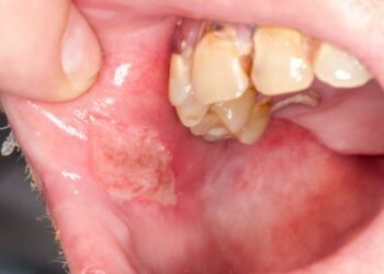 A Global Health Crisis: The Silent Epidemic of Oral Diseases