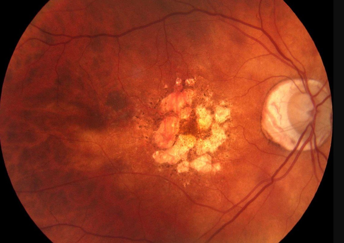 macular disease research grants funding opportunities